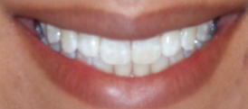 05 after invisalign