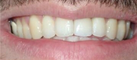 06 after Invisalign