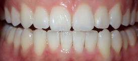 07 after invisalign