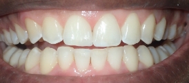 10 after invisalign