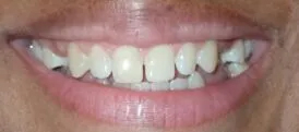 Full Mouth Restorations